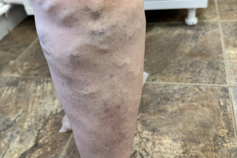 Лечение варикоза после острого тромбоза