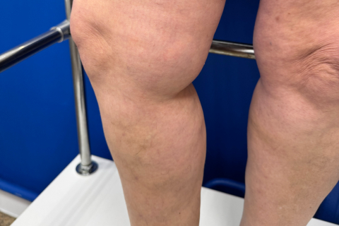 Комплексное лечение варикоза - ЭВЛК, минифлебэктомия и склеротерапия