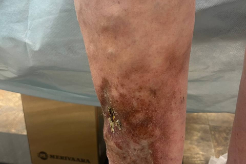 Лечение варикоза с трофической язвой - результат через 45 дней