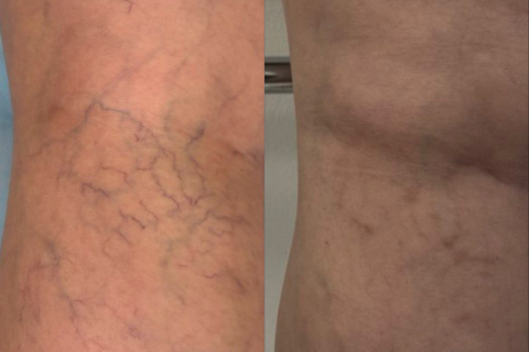 Удаление сосудистых сеток - результат после курса склеротерапии